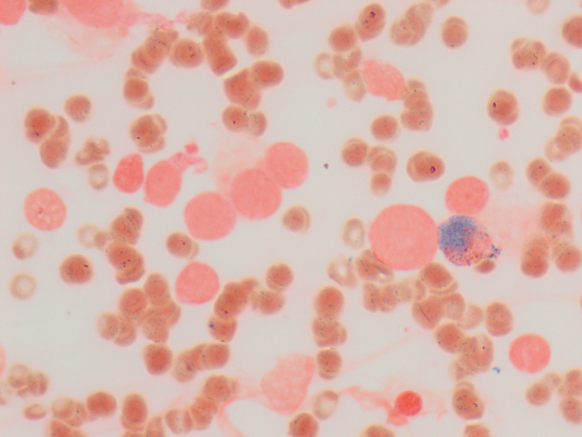 Bone marrow aspirate smear, myeloperoxidase stain, 100x